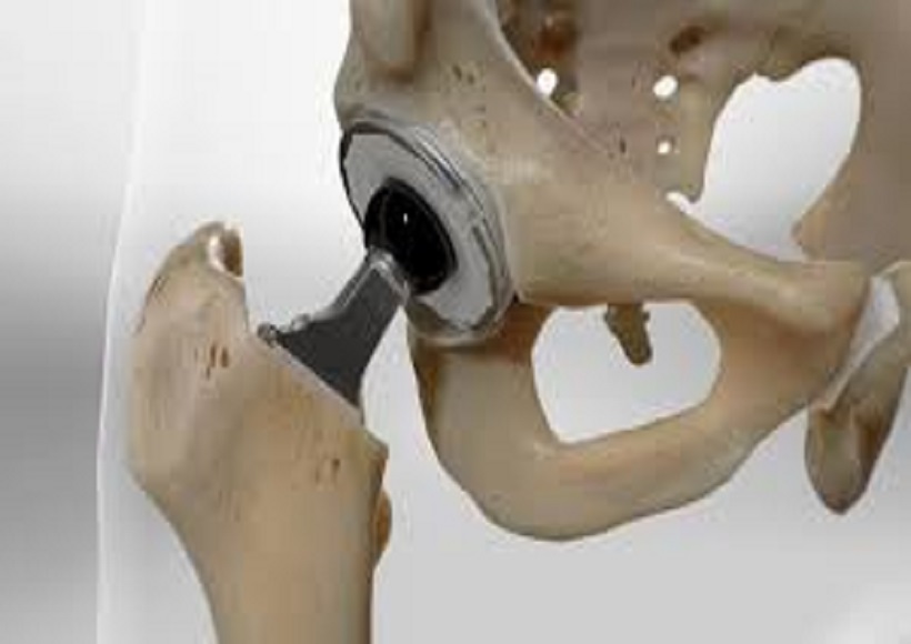 What Is The Cost For A Total Hip Replacement?
